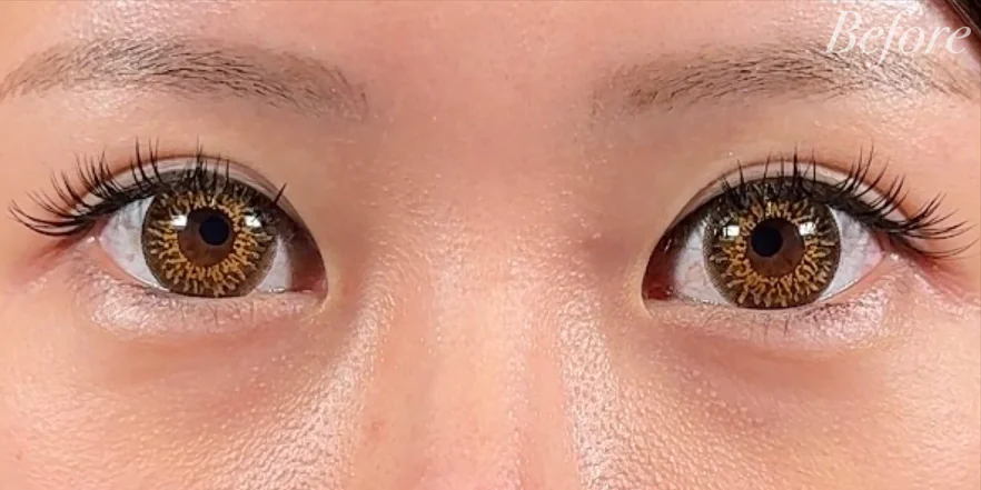 埋没法って何回まで？ (他院で2度、埋没経験のある患者さまの経過)